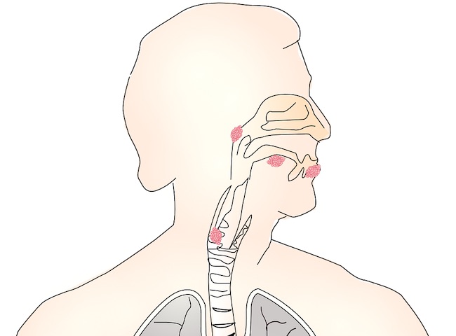 All about apraxia of speech